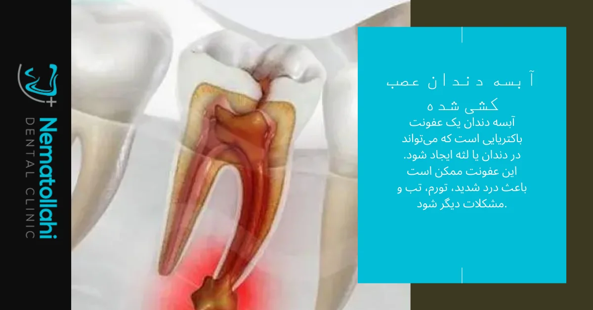 آبسه دندان عصب کشی شده
