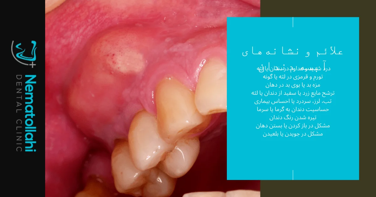 علائم و نشانه‌های آبسه دندان عصب کشی شده