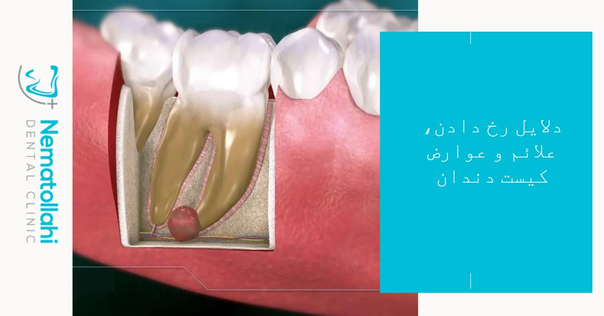 دلایل رخ دادن، علائم و عوارض کیست دندان