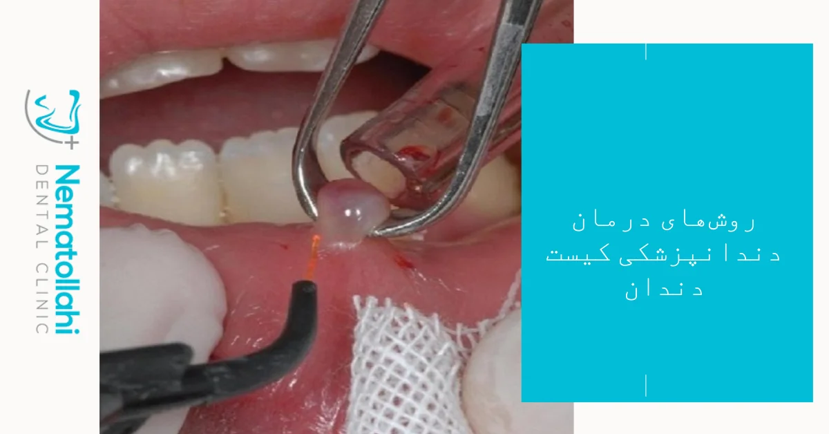 روش‌های درمان دندانپزشکی کیست دندان