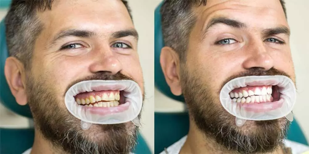 چگونه دندان کامپوزیت شده را سفید کنیم؟