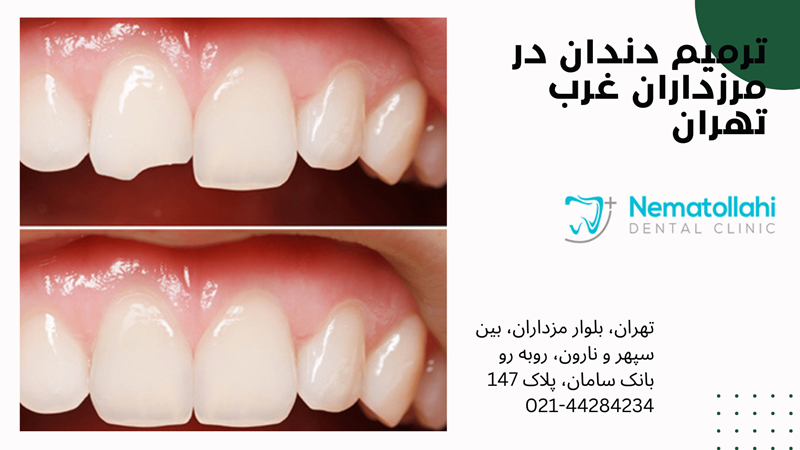 خدمات ترمیمی در دندانپزشکی مرزداران غرب تهران