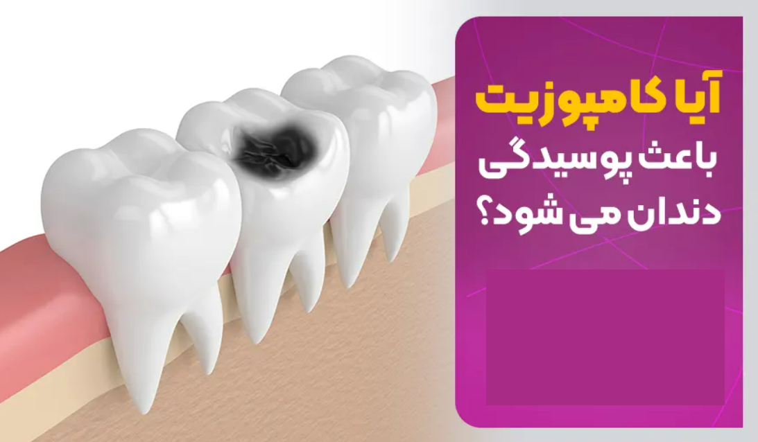 آیا کامپوزیت باعث پوسیدگی دندان می شود؟