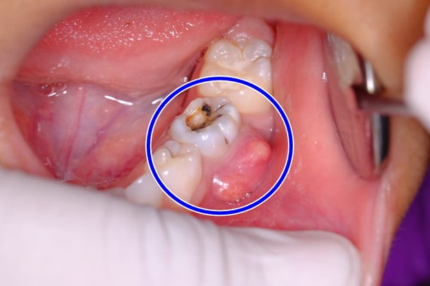 آبسه دندان عصب کشی شده