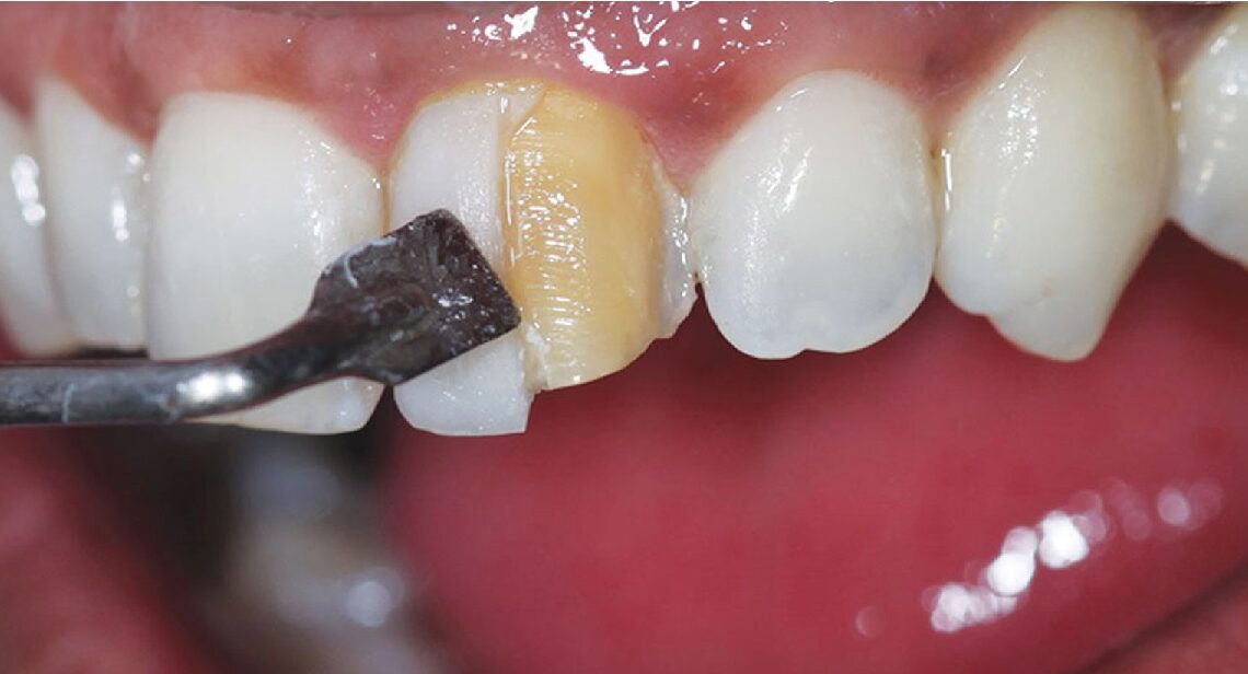 چگونه دندان کامپوزیت شده را سفید کنیم؟