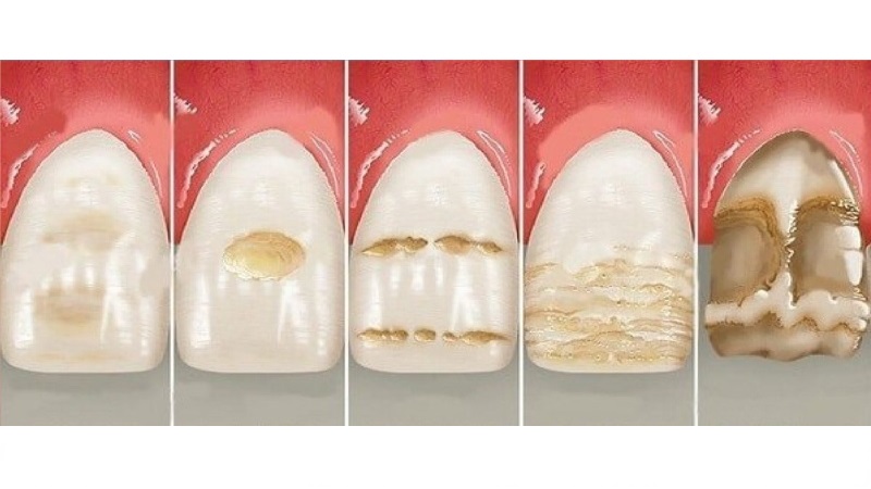 فرسایش مینای دندان یکی از دلایل ایجاد حساسیت به سرما