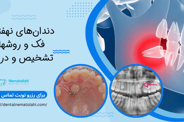 دندان‌های نهفته در فک و روش های تشخیص و درمانی