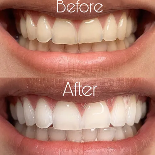 before after whitening teeth