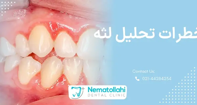 خطرات تحلیل لثه