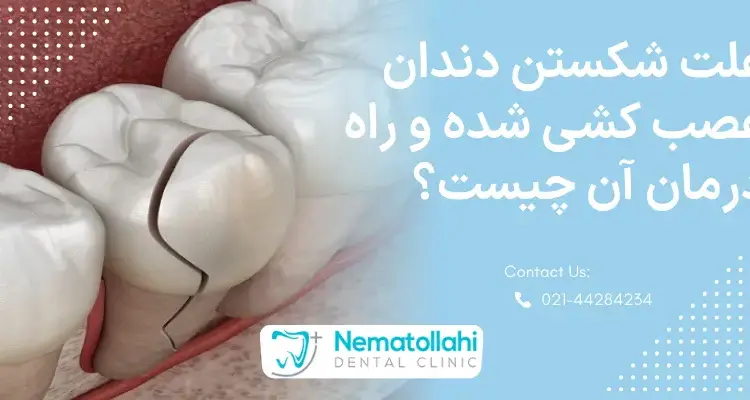 علت شکستن دندان عصب کشی شده و راه درمان آن چیست؟