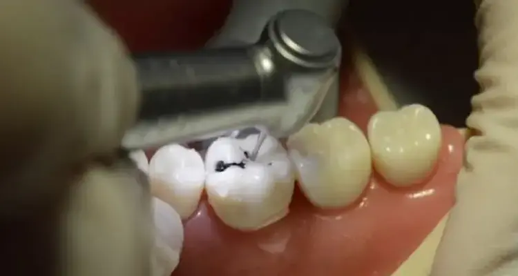 پر کردن سطحی دندان