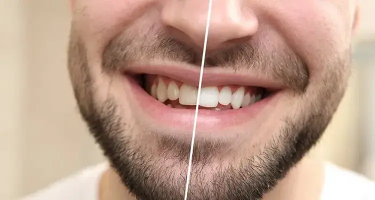 گالری عکس قبل و بعد بلیچینگ