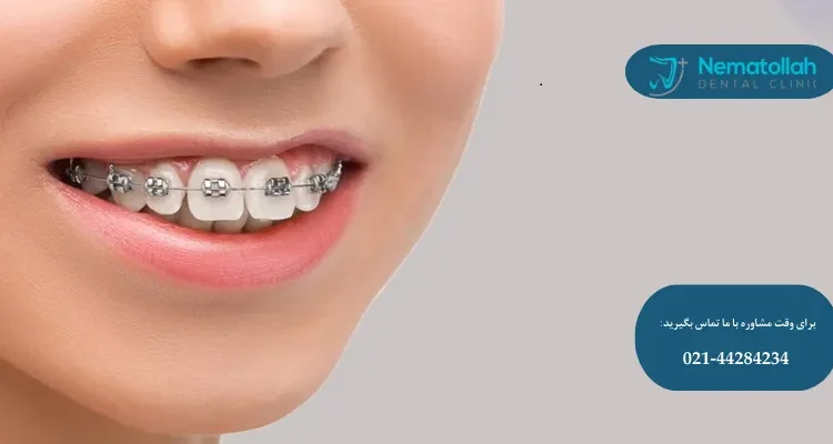 دندان خرگوشی
