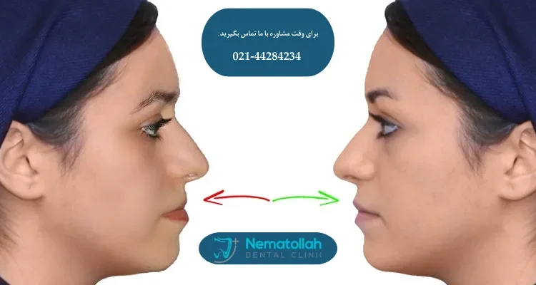 جراحی فک بدون ارتودنسی