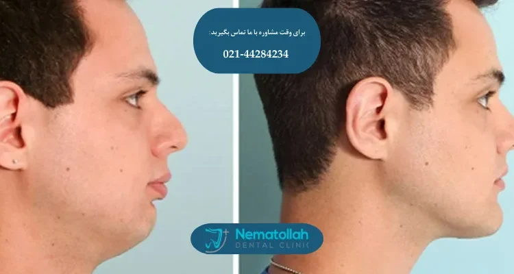 پوشش بیمه تکمیلی برای جراحی فک