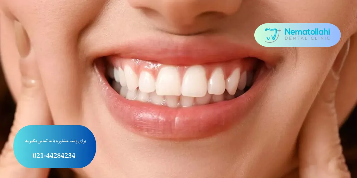 رفع تیرگی لثه با لیزر